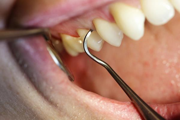 Dental tools cleaning gumline