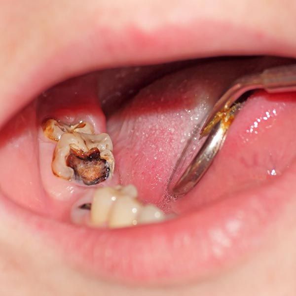Decayed tooth